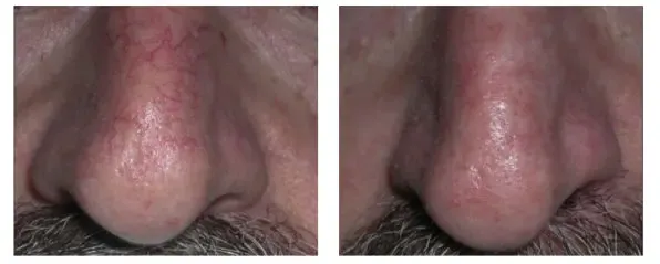 Before and after treatment of telangiectasia on the nose