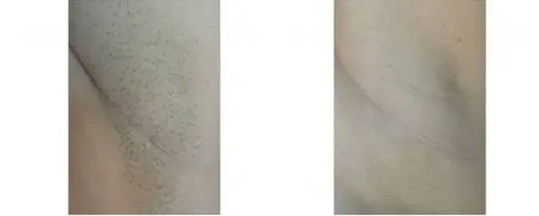 Before and after hair removal on the underarm