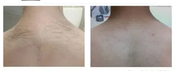 Before and after Lutronic ClarityII treatment, neck and shoulders