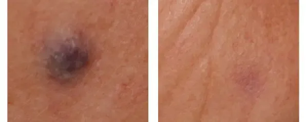 Before and after Lutronic ClarityII treatment of a dark spot