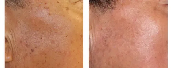 Before and after Lutronic ClarityII treatment of sun spots
