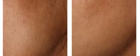 Before and after Lutronic ClarityII treatment, close-up of skin