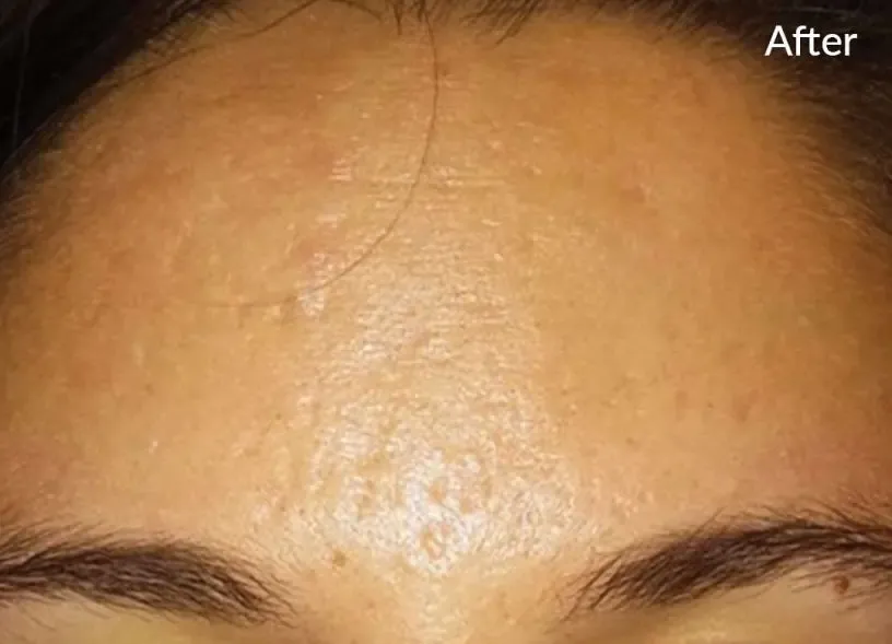 Forehead skin after SkinPen treatment