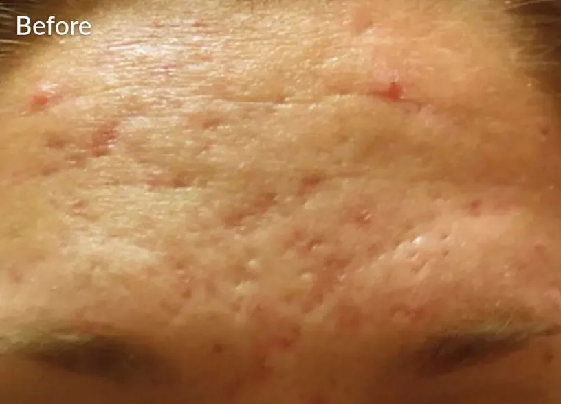 Forehead skin before SkinPen treatment