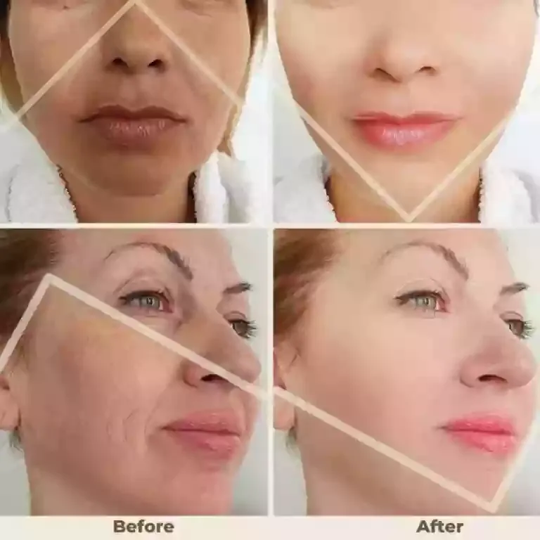 Before and after PDO thread lift
