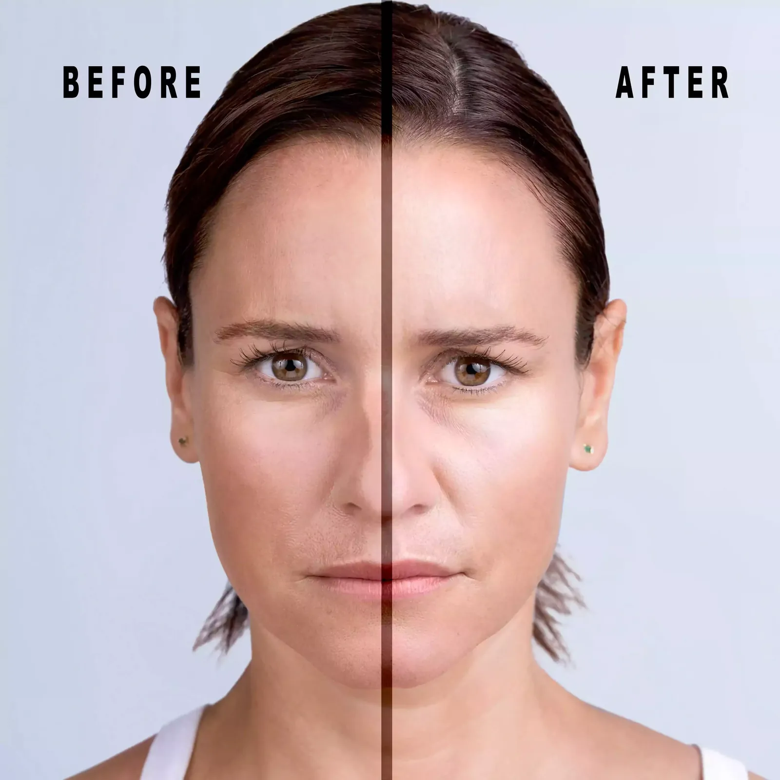 Before and after Xeomin, face split down the middle